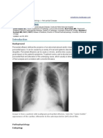 Pericardial Effusion