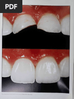 Clinical Performance of Novel-Design Porcelain Veneers For The Recovery of Coronal Volume and Length