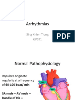 Arrhythmias: Sing Khien Tiong Gpst1