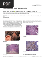 Congenital Scalp Tumor With Ulceration: Jeremy Udkoff MA, MAS - Ralph E. Holmes MD - Magdalene A. Dohil MD