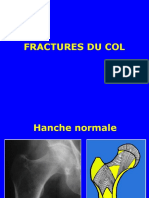 02 - Fract Ext Sup Femur