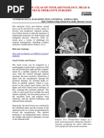 Anterior Skull Base Resection External Approaches