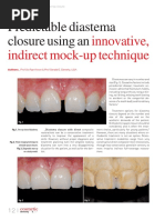 Innovative, Indirect Mock-Up Technique: Predictable Diastema Closure Using An