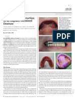 A Unique Reconstruction of An Implant-Retained Denture: Step-by-Step