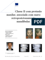 Caso de Classe II Com Protusão Maxilar, Associada Com Suave Retroposicionamento Mandibular