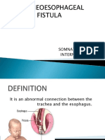 Tracheo-Oesophageal Fistula