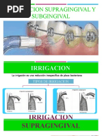 Irrigaccion Supragingival y Subgingival Perio