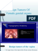 Benign Tumors of Female Genital Organs