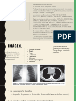 Tumores Del Mediastino, Completo