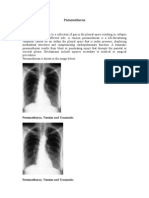 Pneumothorax