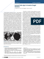 Reversed Halo Sign in Invasive Fungal Infections