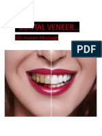 Dental Veneer