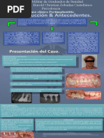 Caso Clínico Periimplantitis