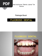 Fluorosis Dental