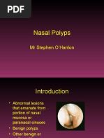 Nasal Polyps: MR Stephen O'Hanlon