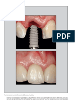 Prospective Evaluation of A Novel Implant Designed For Immediate Loading