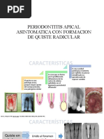 Periodontitis Apical Asintomatica Con Formacion de Quiste Radicular