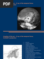 Imaging of The Ear - X Ray of The Temporal Bone, Schuller's Projection