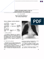 Hipertension Pulmonar