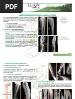 Semiologia Radiologica de Fracturas