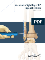 Syndesmosis Tightrope XP Implant System: Surgical Technique