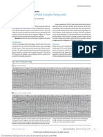 An Important Cause of Wide Complex Tachycardia: Case Presentation