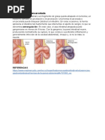 Hernia Inguinal Encarcelada