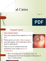 Dental Caries Lect 4