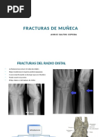 Fractura de Muñeca