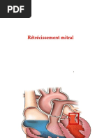 1-Rétrecissement Mitral