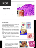 Neoplasia