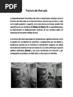 Fractura Del Ahorcado