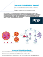 Leucemia Linfoblastica Aguda