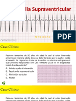 Taquicardia Supraventricular