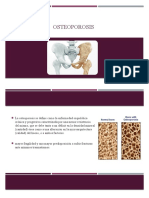 Osteoporosis - PPTX Joel