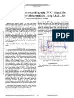 Analysis of Electrocardiograph Ecg Signal For The Detection of Abnormalities Using Matlab