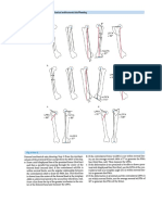 Dror Paley - Principles of Deformity Correction (2002, Springer-Verlag Berlin Heidelberg) - 100-300