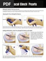 Arthrex Meniscal Cinch