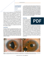 Pupil Capture of Intraocular Lens in Vitrectomized Eye With Primary Pigment Dispersion Syndrome