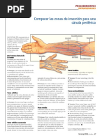 Comparar Las Zonas de Inserción para Una Cánula Periférica: Intravenosos