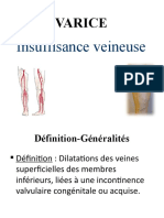 Varice: Insuffisance Veineuse