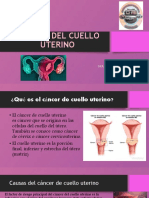 Cancer Del Cuello Uterino