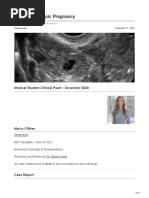 Sjrhem - Ca-A Case of Ectopic Pregnancy