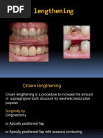 Crown Lengthening