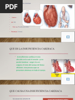 Insuficiencia Cardiaca