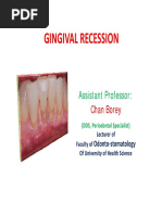 14 - Gingival Recession