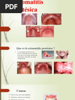 Estomatitis Protésica