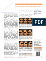 Treatment of Dark Circles With The New 15 MGML Hyaluronic Acid Filler With Lidocaine