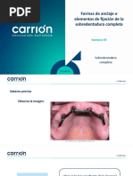 PSA5 PD II Sobredentadura Completa