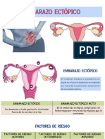 Embarazo Ectopico